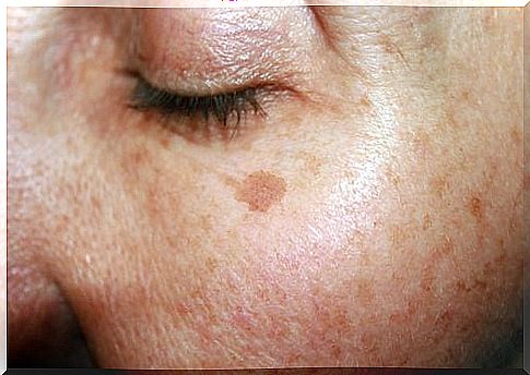 age spots on the face