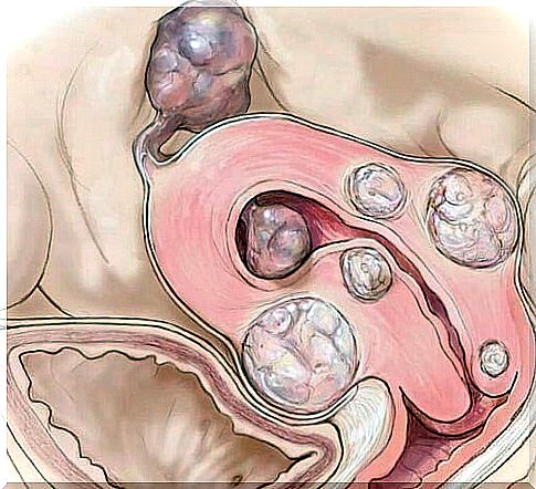 Uterine fibroma