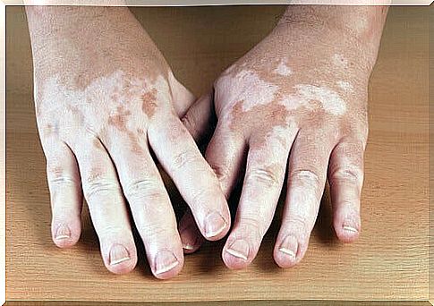 5 home remedies for vitiligo