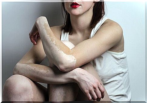 remedies for vitiligo