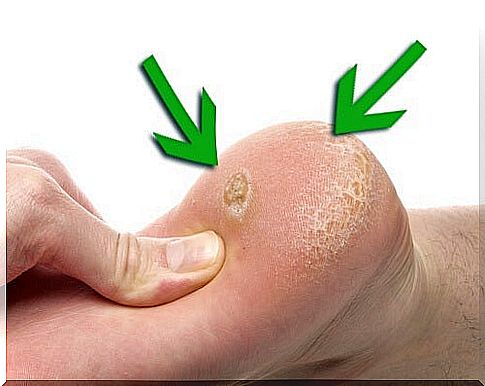 7 ingredients we have at home to get rid of warts