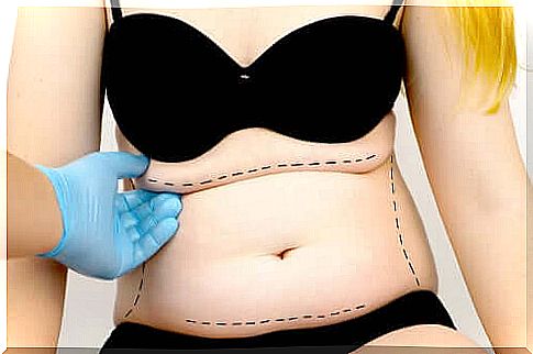 Abdominoplasty: what does it consist of?