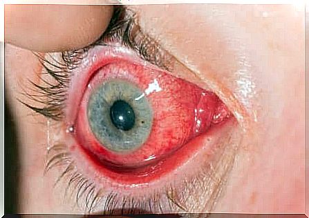 Allergic conjunctivitis.