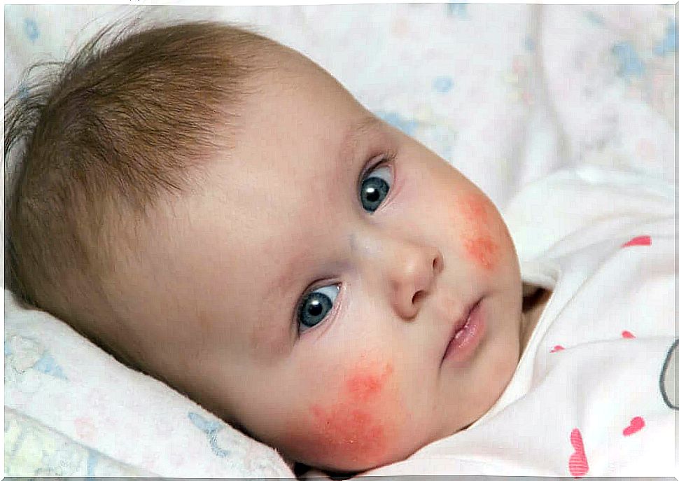 Atopic dermatitis of the newborn