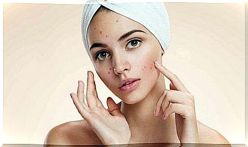 Beauty secrets with apple cider vinegar for acne