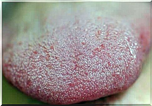 White spots on the tongue.