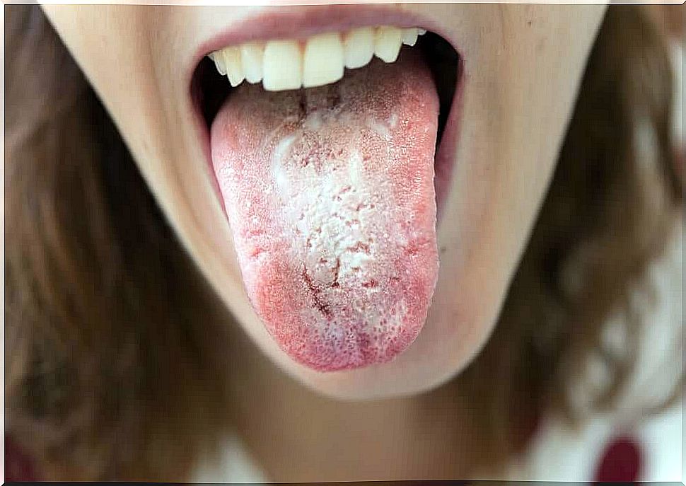 Symptoms of tongue discomfort.