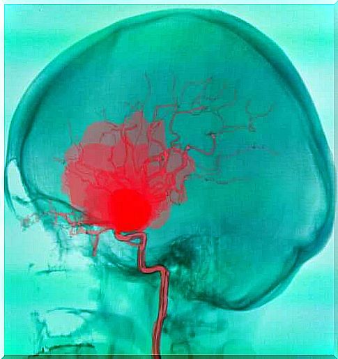 Cerebral hemorrhage