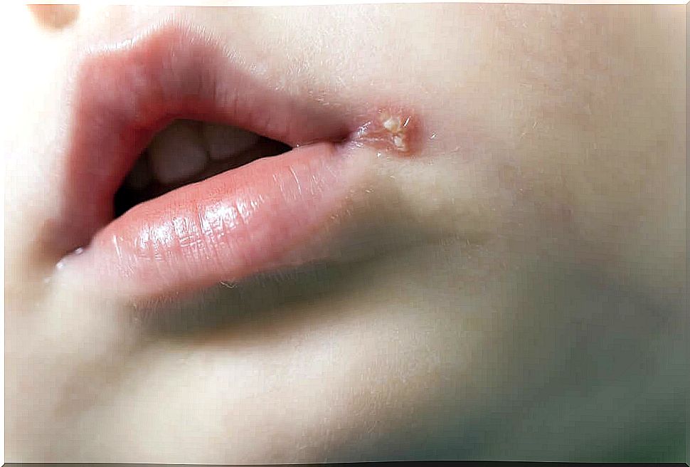 Child with cold sores or fever on the lips