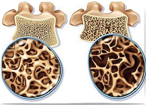 Exercises to prevent and treat osteoporosis