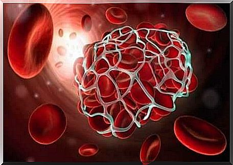 Thrombosis in the body.