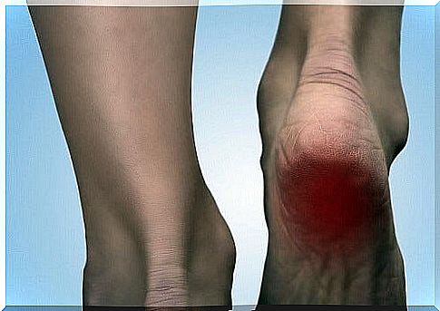 Home remedies for heel spurs