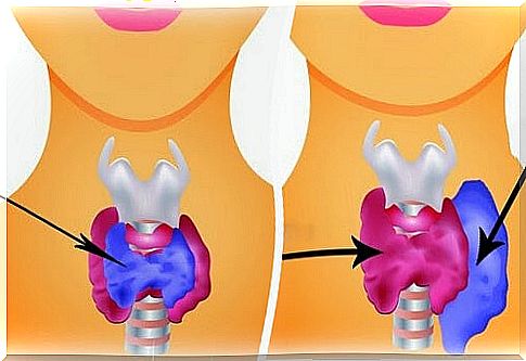 example of hyperthyroidism