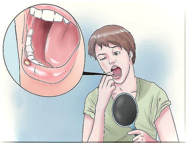 Mouth ulcers: 8 natural remedies