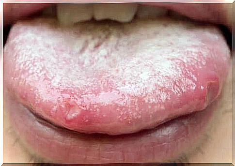 Oral Candida: Alternative Natural Remedies