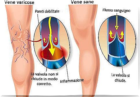 Preventing varicose veins, here's how