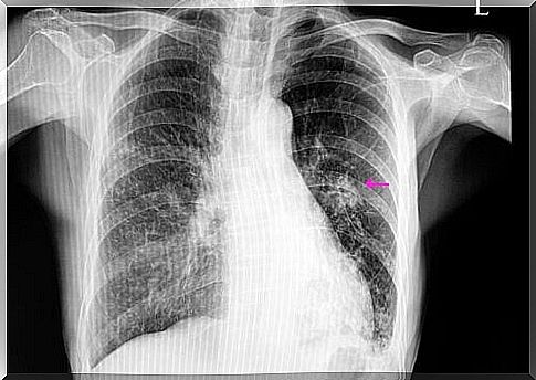 Pulmonary nodule: diagnosis and treatment