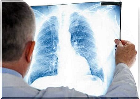 Pulmonary nodule diagnosed on lung x-ray