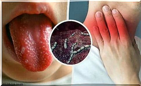 Scarlet fever and tongue with white spots.