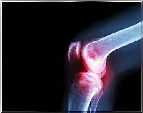 Septic Arthritis: Causes, Symptoms, and Treatments