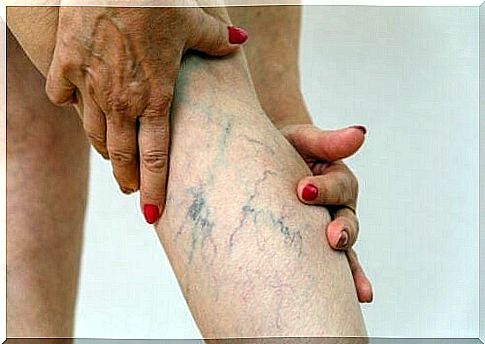 Thrombophlebitis: causes, symptoms and treatment