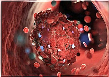 Thrombophlebitis and blood clot in the vein.