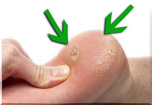 Treating calluses naturally, here's how