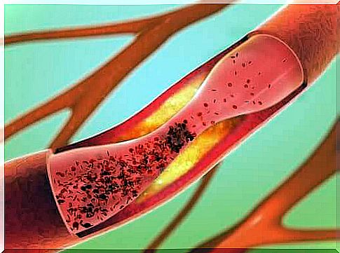 Cerebrovascular haemorrhage